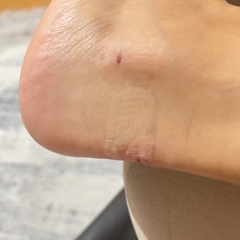 SuperStep'ten Aldığım Ayakkabı Ayağımı Yara Yaptı