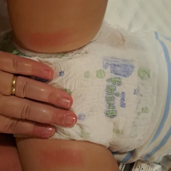 Penti Bikini Kumaşı Kızımı Tahriş Etti