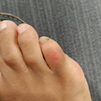 Derimod Ayağımı Yara Eden Sandaleti Ne Geri Aldılar Ne De Değişim Yaptılar