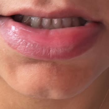 Sensodyne Alerjik Reaksiyona Sebep Oldu