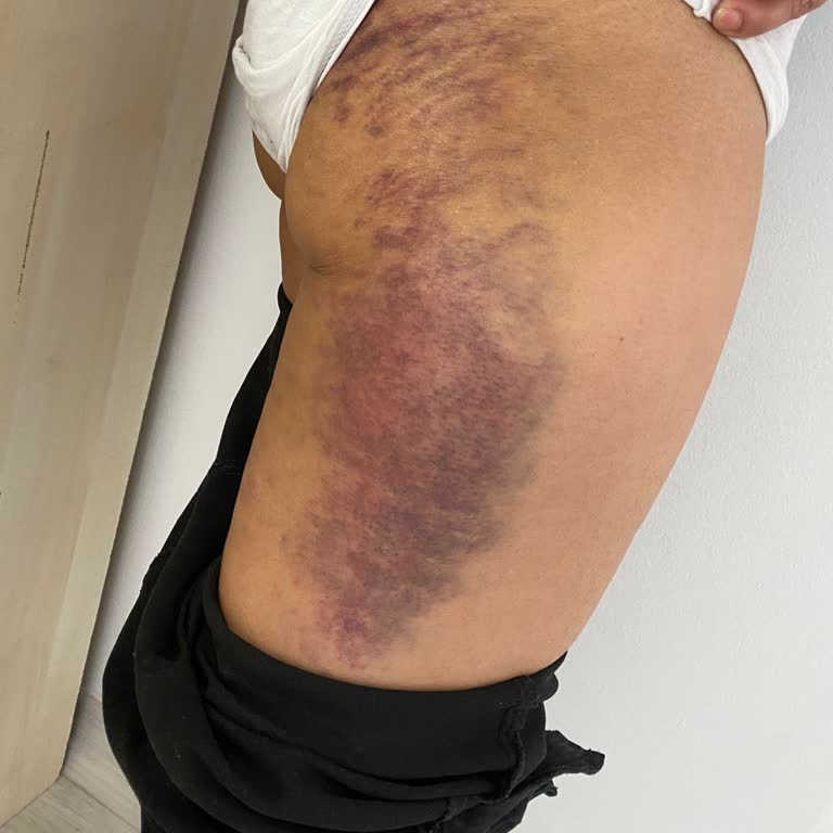 Büşra Aydemir Estetik G5de Yapılan Morluklar