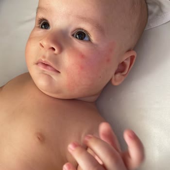 Mustela Bebeğimin Yüzünü Mahvetti