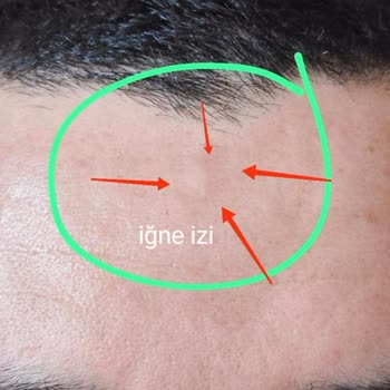 Op. Dr. Seyithan Kırtay Burnumun İçinde Büyük Et Parçası Kaldı!