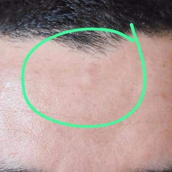 Op. Dr. Seyithan Kırtay Burnumun İçinde Büyük Et Parçası Kaldı!