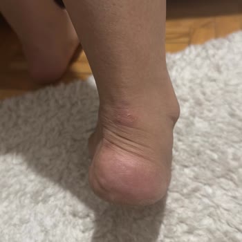 Stradivarius Ayakkabı Ayağımı Yara Yaptı