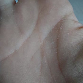 Activex Hassas Sıvı Sabun Egzama Yapıyor