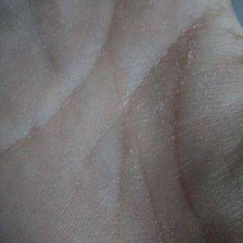 Activex Hassas Sıvı Sabun Egzama Yapıyor