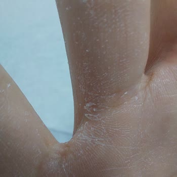 Activex Hassas Sıvı Sabun Egzama Yapıyor