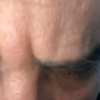 Estrella Medical Group Hayal Kırıklığı: Botox Ve Dolgu İşlemleri Başarısız