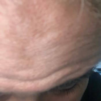 Estrella Medical Group Hayal Kırıklığı: Botox Ve Dolgu İşlemleri Başarısız