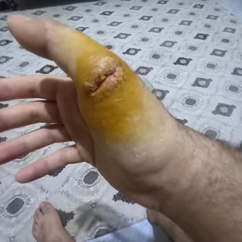 Liv Hospital Yanlış Tedavi Sonucu Mağduriyet