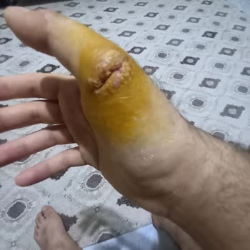 Liv Hospital Yanlış Tedavi Sonucu Mağduriyet