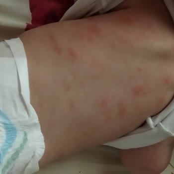 Sma Optipro Alerjisi