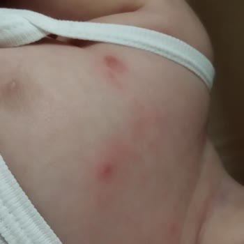 Sma Optipro Alerjisi