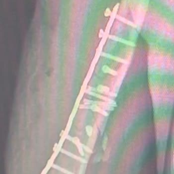 Safa Hastanesi Doktorun İlgisiz Ve Özensiz Ameliyatı