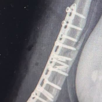 Safa Hastanesi Doktorun İlgisiz Ve Özensiz Ameliyatı