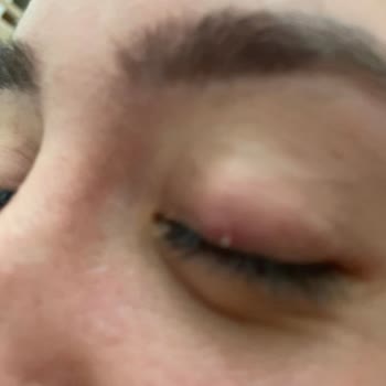 Adana Niv Göz Şalazyon Ameliyatı Sonrası