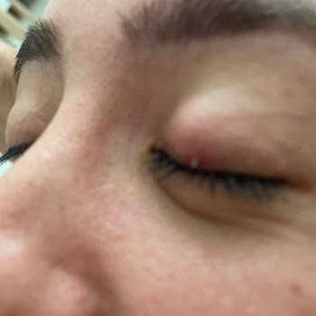 Adana Niv Göz Şalazyon Ameliyatı Sonrası