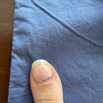 Pronail Manikür Ve Pedikür Sonrası Ciddi Sorunlar Yaşadık