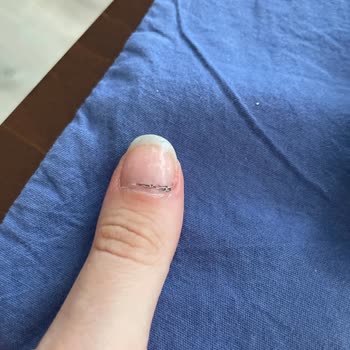 Pronail Manikür Ve Pedikür Sonrası Ciddi Sorunlar Yaşadık