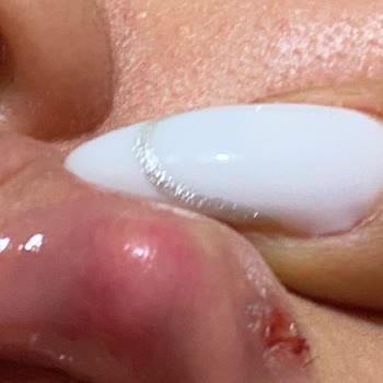 Luxe Vip Güzellik Estetik Keçiören'deki Güzellik Salonunda Dudak Dolgusu Sorunu