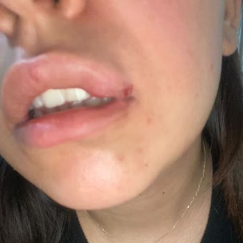 Luxe Vip Güzellik Estetik Keçiören'deki Güzellik Salonunda Dudak Dolgusu Sorunu