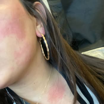 Luxe Vip Güzellik Estetik Keçiören'deki Güzellik Salonunda Dudak Dolgusu Sorunu