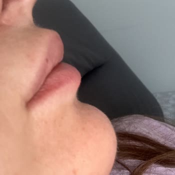 Mia Plus Clinic Dudak Dolgusu İstedim Bıyık Dolgusu Yaptılar