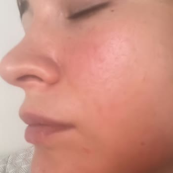 Mia Plus Clinic Dudak Dolgusu İstedim Bıyık Dolgusu Yaptılar