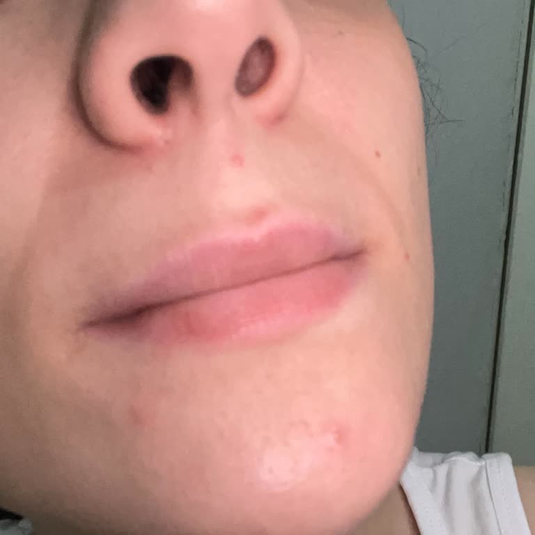 Watsons'tan Aldığım Retinol Sivilce Yaptı