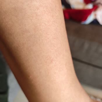 Nivea Güneş Kremi Alerji Yaptı