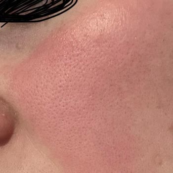 Eyüp Sabri Tuncer Ciltte Yanma Ve Kızarıklık Yapan Tonik