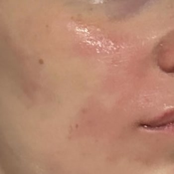 Eyüp Sabri Tuncer Ciltte Yanma Ve Kızarıklık Yapan Tonik