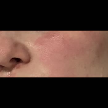 Eyüp Sabri Tuncer Ciltte Yanma Ve Kızarıklık Yapan Tonik