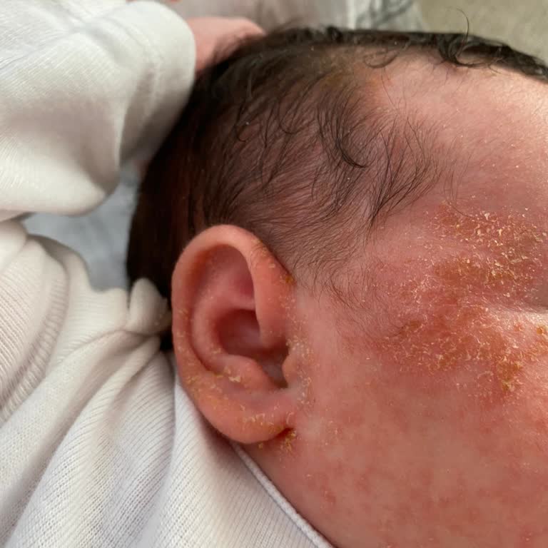 Dalin Şampuan Egzama Yaptı