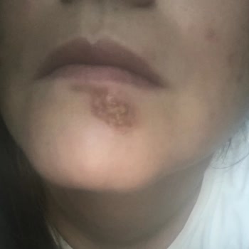 Nivea Yanlış Güneş Kremi Tavsiyesi Sonucu Alerji Sorunu