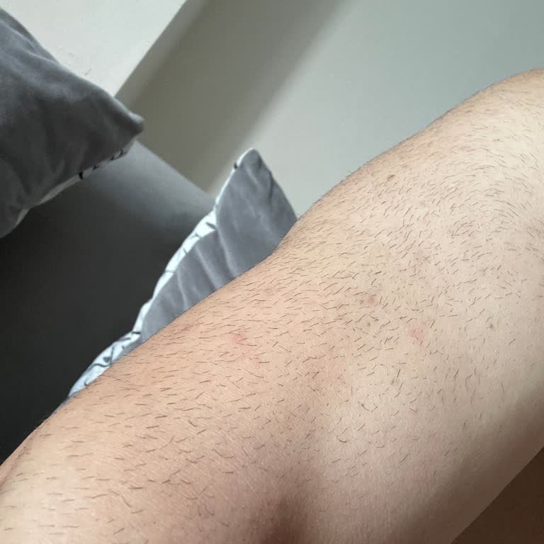 Doğa Hospital Lazer Epilasyon İşlemi