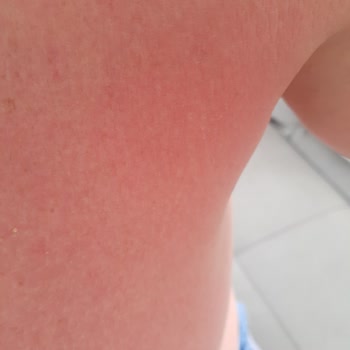 Eda Taşpınar Bronzlaştırıcı Ürün Kaşıntı Ve Kızarıklık Yaptı