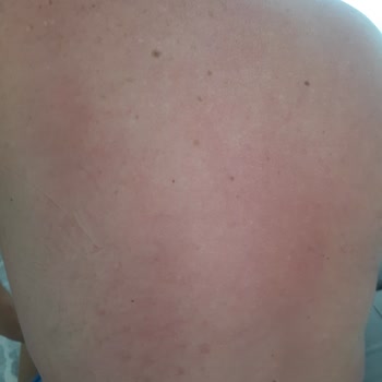 Eda Taşpınar Bronzlaştırıcı Ürün Kaşıntı Ve Kızarıklık Yaptı