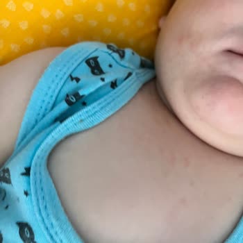 Nurse Harvey’s Nurse Harvey's Diş Jeli Bebeğe Alerji Yaptı!