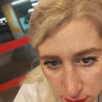 Sante Plus Hastanesi Rinoplasti Ameliyatı Sonrası Hayal Kırıklığı