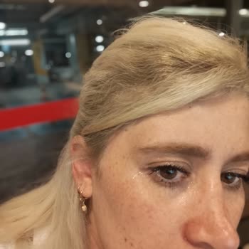 Sante Plus Hastanesi Rinoplasti Ameliyatı Sonrası Hayal Kırıklığı