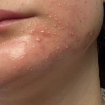 Neutrogena Sivilce Karşıtı Seri Alerji Ve Kusma Yaptı!