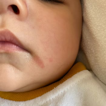 Orzax İlaç Bebek Ürünlerinde Kızarıklık Sorunu