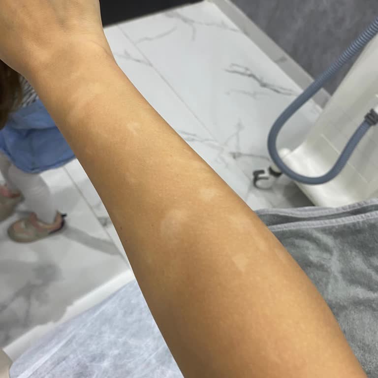 Aris Güzellik Merkezleri Vücudumu Yaktılar Ve Özür Bile Dilemediler