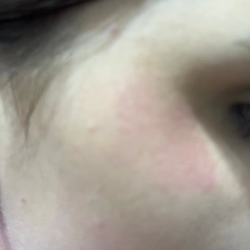 Yves Rocher Yüz Yıkama Jeli Yüzde Kızarıklık Yapıyor