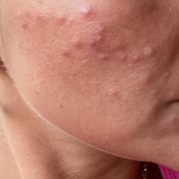 Btxcream.tr Cildimi Mahvetti