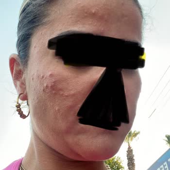 Btxcream.tr Cildimi Mahvetti