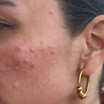 Btxcream.tr Cildimi Mahvetti