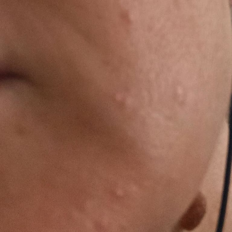 Bioxcin Collagen 5& Serum Cilde De Cebe De Zararlı. Dikkat...